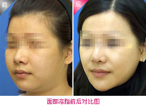 吸脂瘦脸，重塑面部轮廓的现代美学选择
