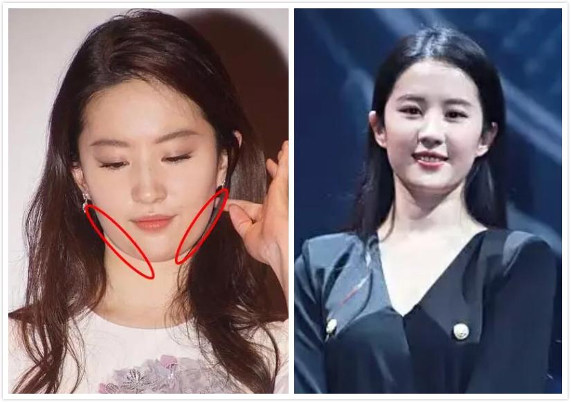 现代审美新趋势，下巴整容整形——追求完美轮廓的背后