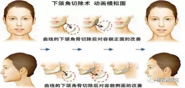 眉弓填充，重塑面部轮廓的微妙艺术