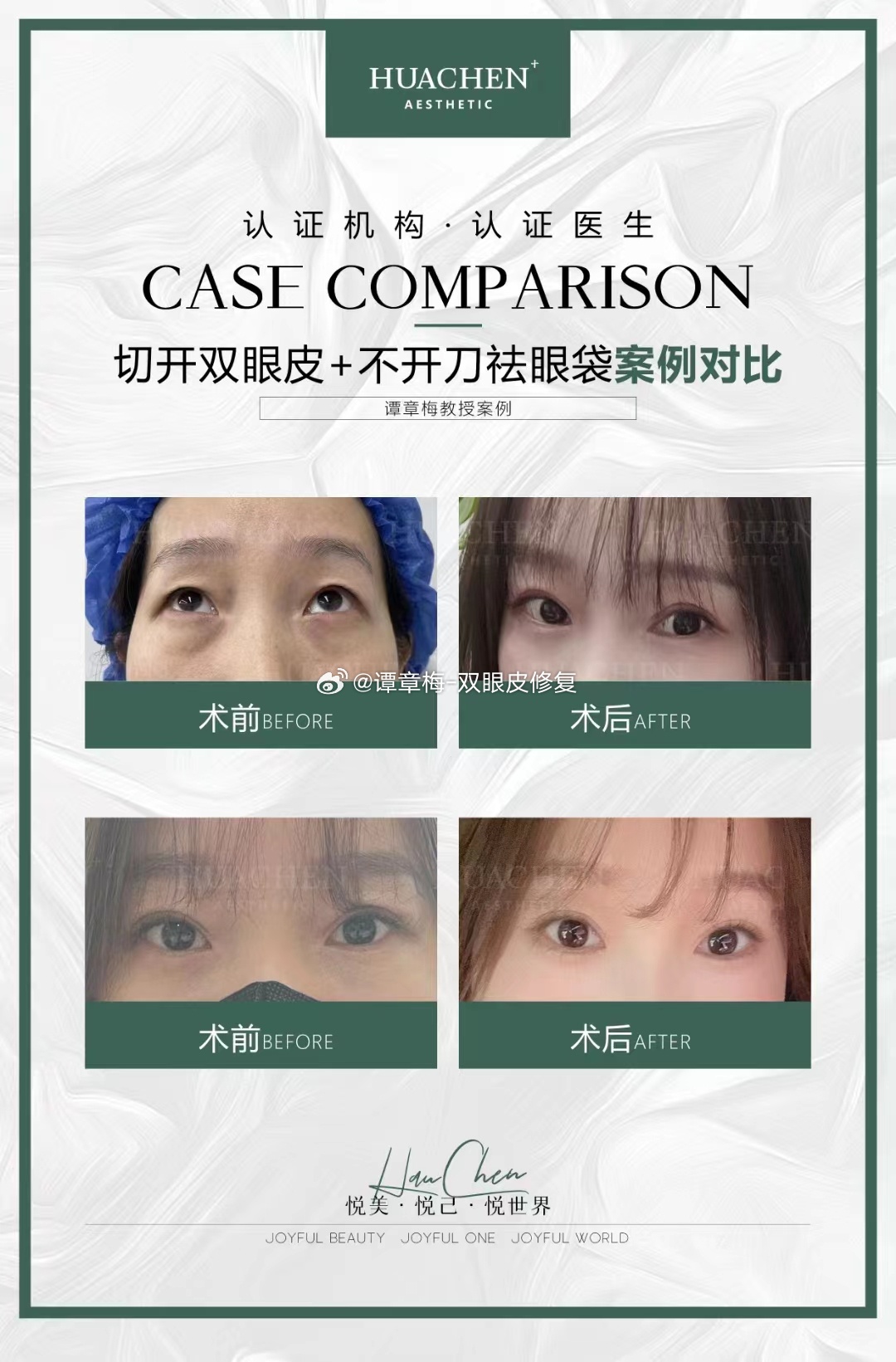 探索无刀之境，不动刀双眼皮的魅力与奥秘