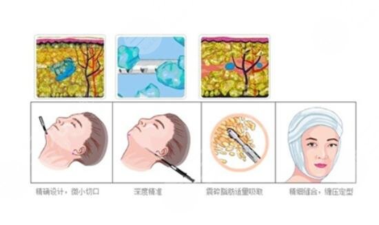 面部抽脂瘦脸，重塑自信的美丽之旅