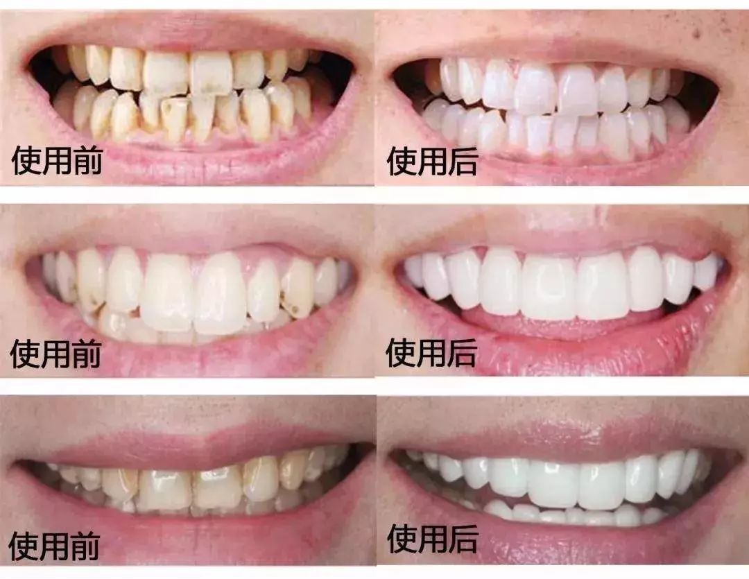 美白牙齿的多种方法与科学指南