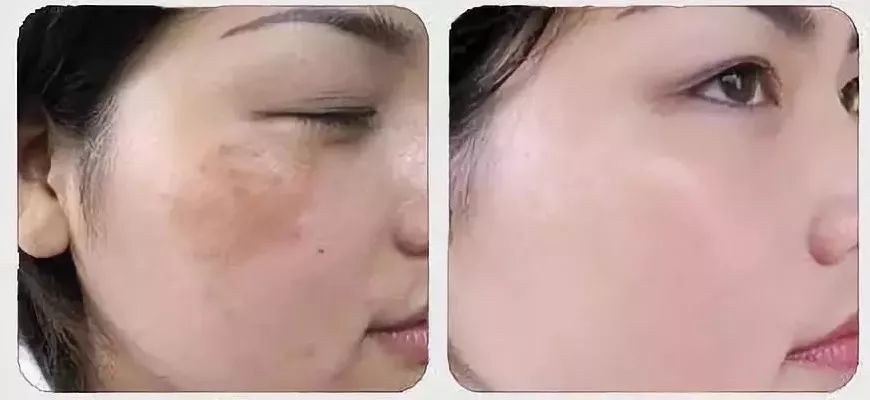 激光技术，黄褐斑的隐形杀手