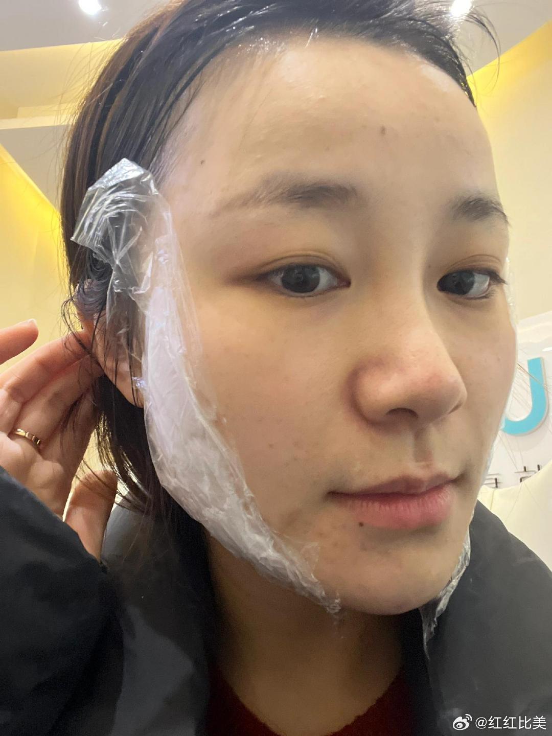 打瘦脸针，几天后见效果？