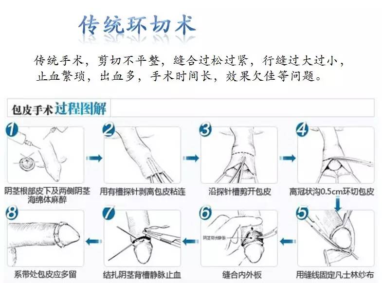 包皮手术，男性健康的新视角