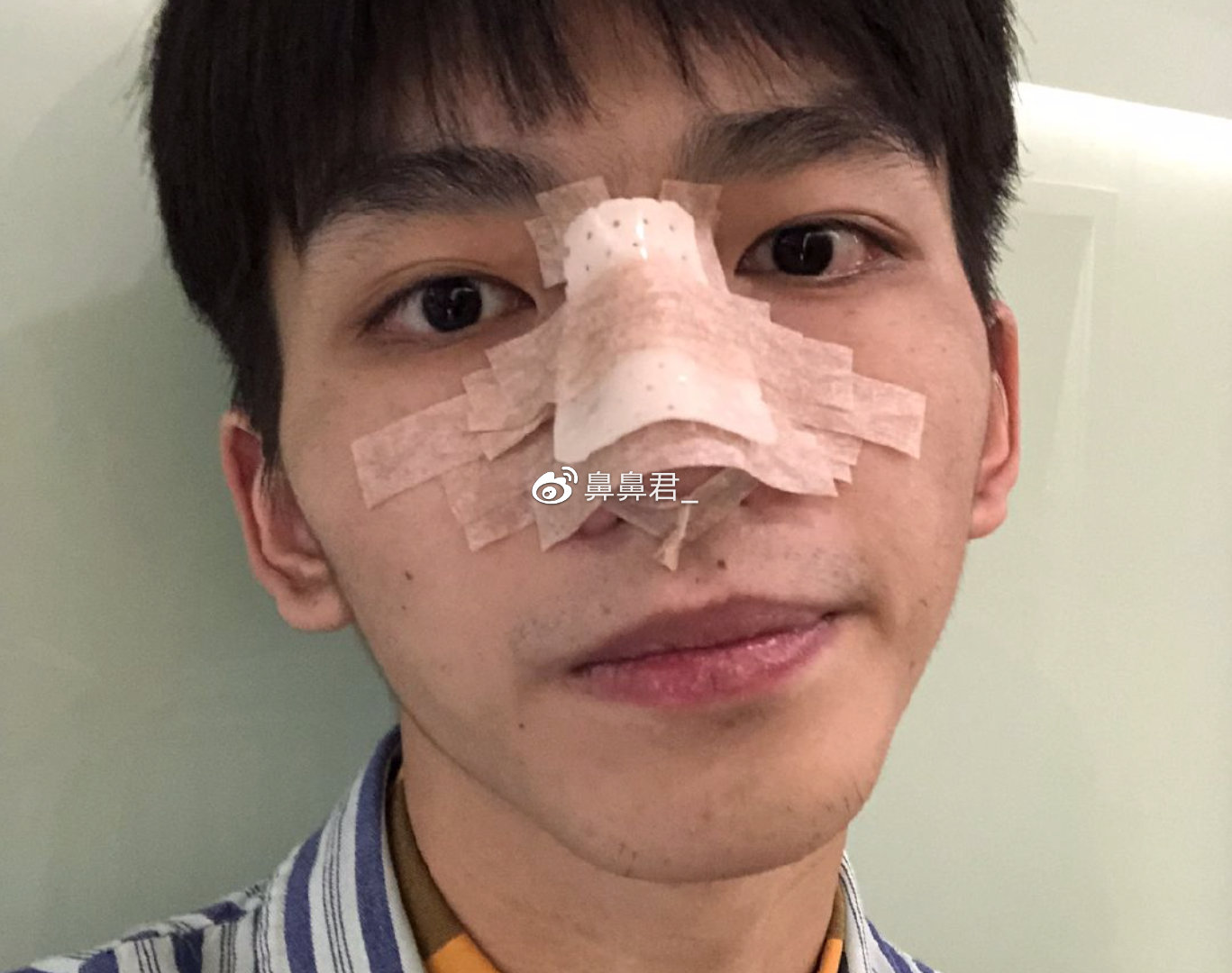 男性隆鼻，重塑自信与魅力的艺术