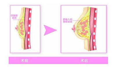 隆胸材料，选择与安全并重的现代美容科技