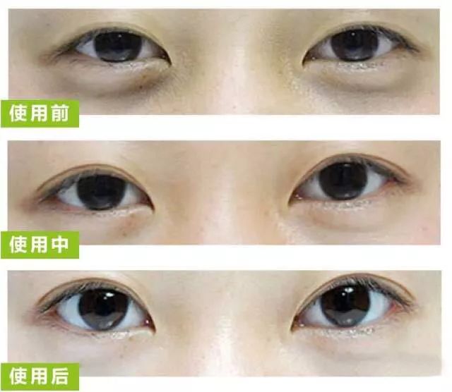 修复眼袋，重焕眼部青春的秘密武器