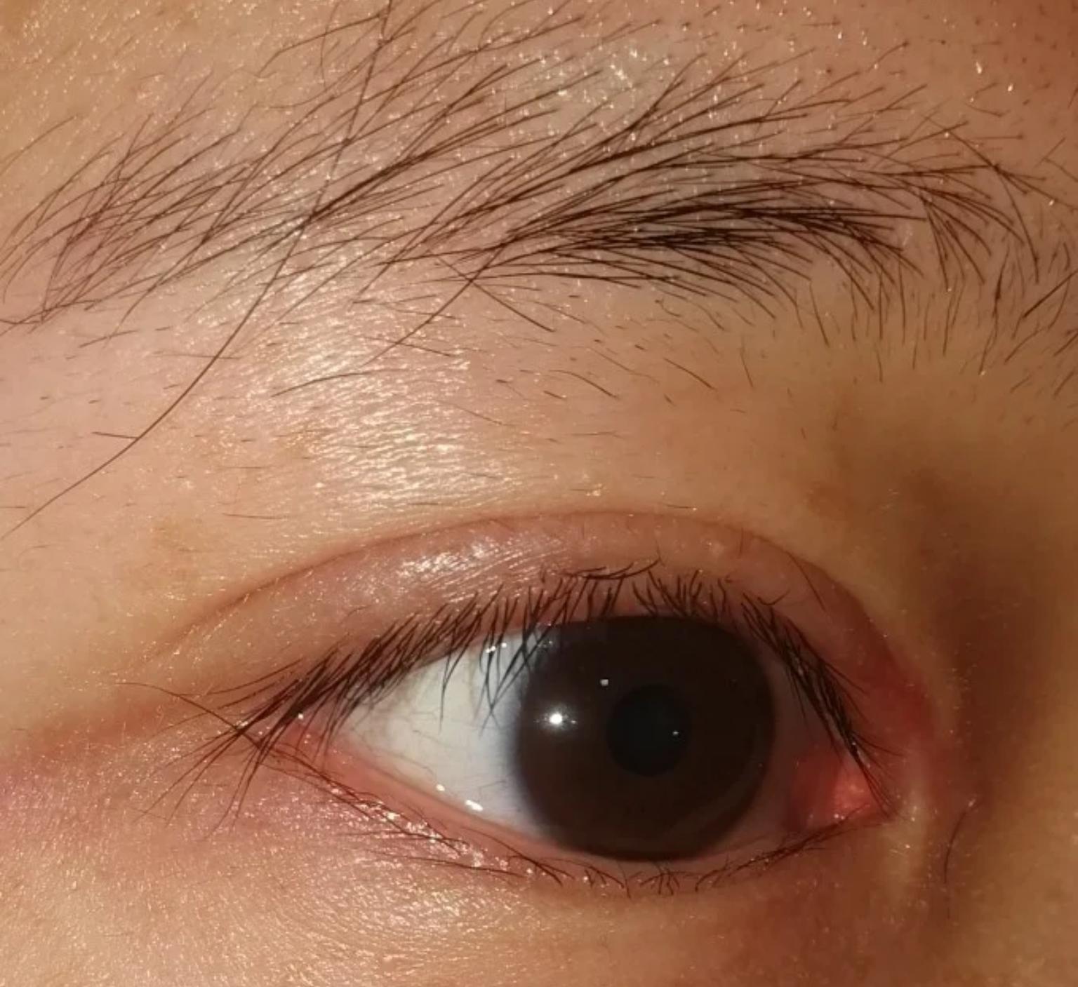 开眼角的潜在风险与考量