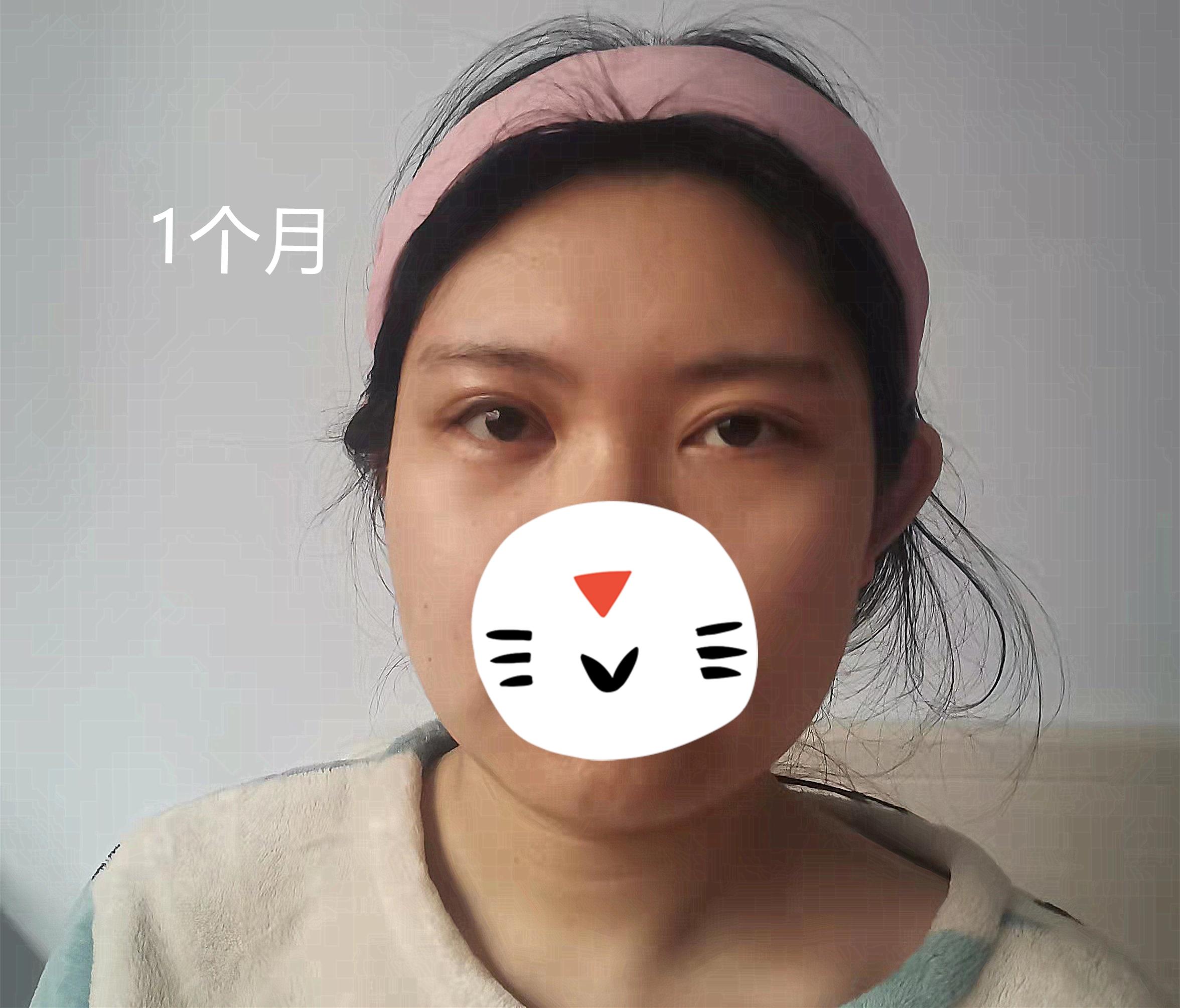 重塑明眸，上睑下垂整形的奥秘与效果