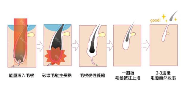 激光脱毛，价格与价值的深度剖析