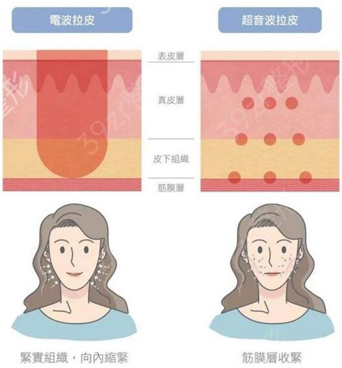探秘拉皮手术价格，一次拉皮究竟多少钱？