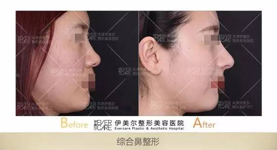 假体隆鼻失败，美丽背后的隐痛与修复之路
