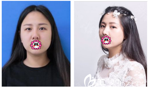 鼻部形状整形的艺术与科学，重塑面部轮廓的精细手术