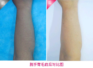 手臂脱毛的全面指南，从传统到现代的多种方法