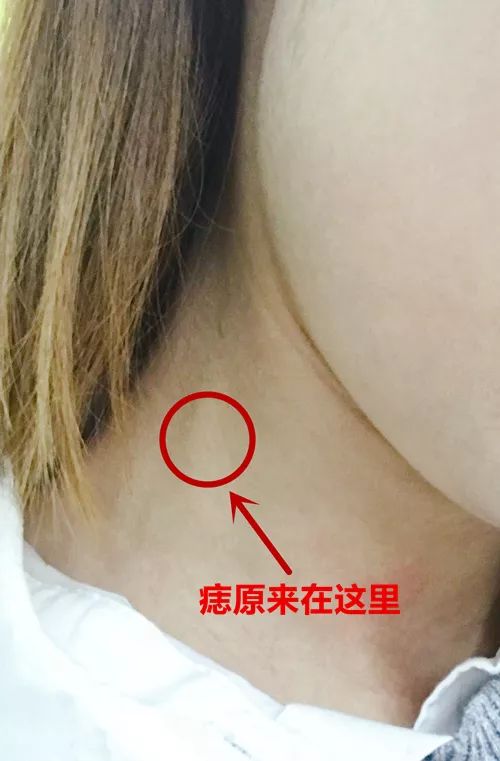 祛除手术疤痕，现代医学的奇迹与个人自信的重生