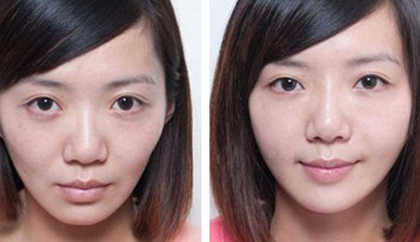 脸部自体脂肪填充，价格与美丽之间的平衡