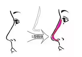 韩式隆鼻手术，打造完美鼻型的艺术与科学