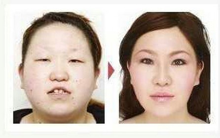 鼻部重塑，大鼻头整形的艺术与科学
