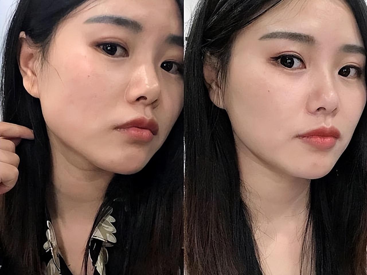 打完瘦脸针后的全面护理与注意事项
