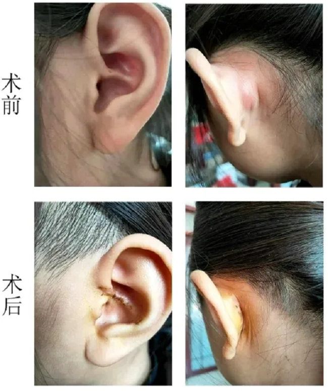 耳前瘘管手术，从疑惑到安心的健康之旅
