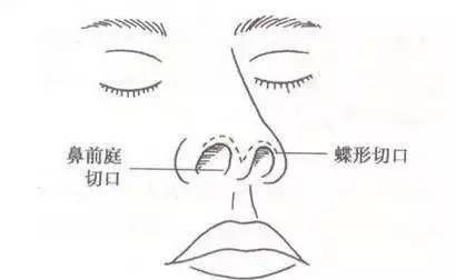 怎样自然地使鼻翼缩小，科学方法与日常技巧