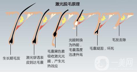 脱毛多少钱，全面解析与价格指南