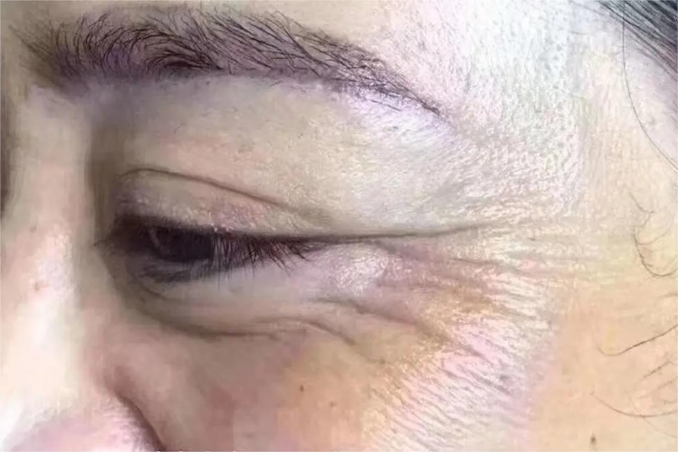 鱼尾纹手术，解锁年轻态的秘密