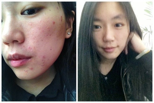 祛痘产品排行榜10强，告别痘痘，重拾自信肌肤