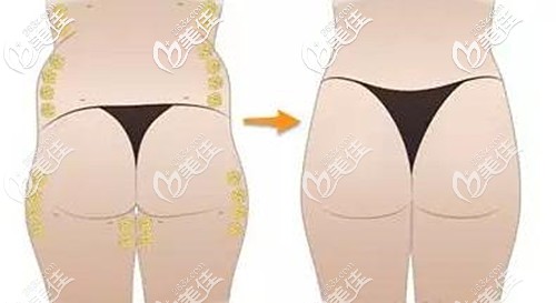 探索大腿部抽脂，了解、风险与恢复