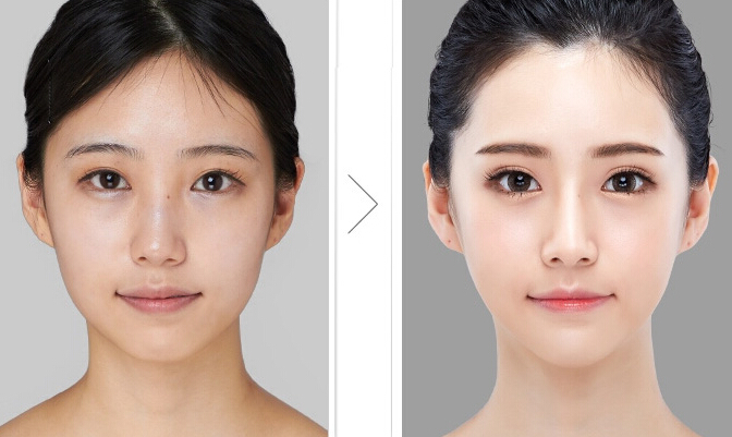 面部吸脂修复，重塑自然美学的艺术