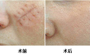 手术疤痕修复，重塑肌肤之美的新篇章