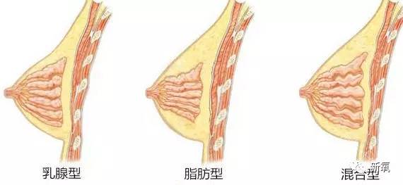 脂肪隆胸，价格与美丽的平衡艺术