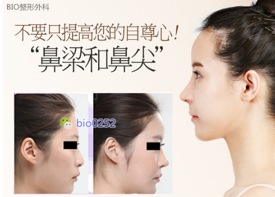 隆鼻整形术，重塑自信的美丽之选