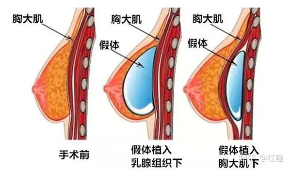 隆胸手术，从视频中了解的真相与误区