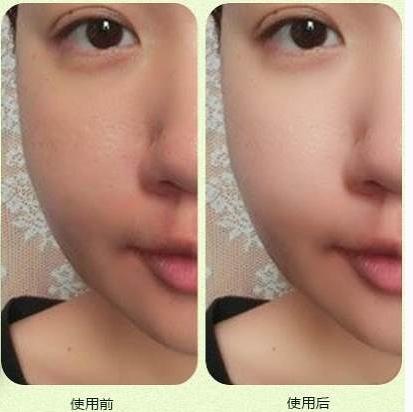 美白针，科学解读打几次有效果的疑问