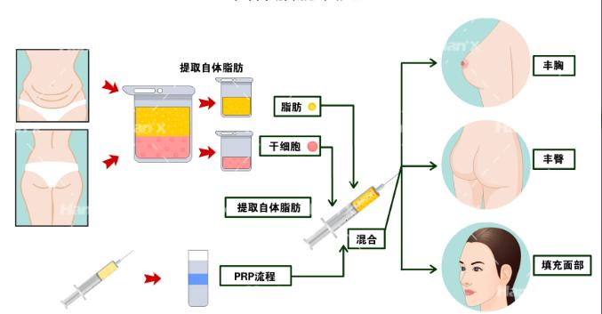 臀部吸脂术，重塑完美曲线的新选择