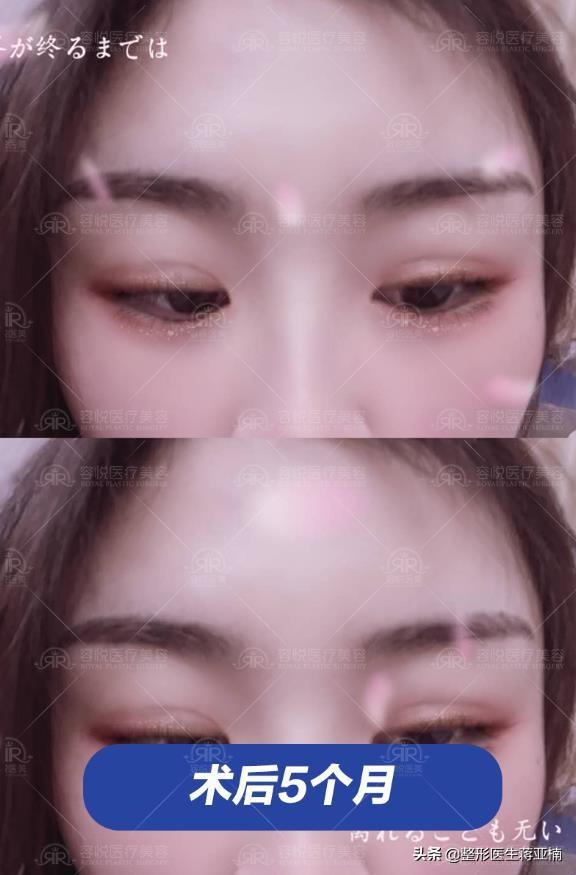韩式定位双眼皮，打造自然灵动美眸的秘诀