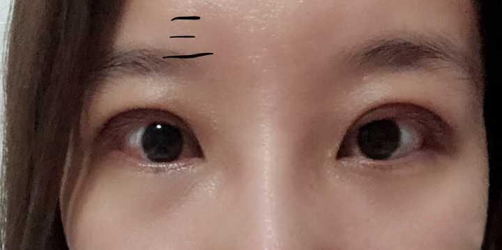 双眼皮失败修复，重拾自信的美丽之旅