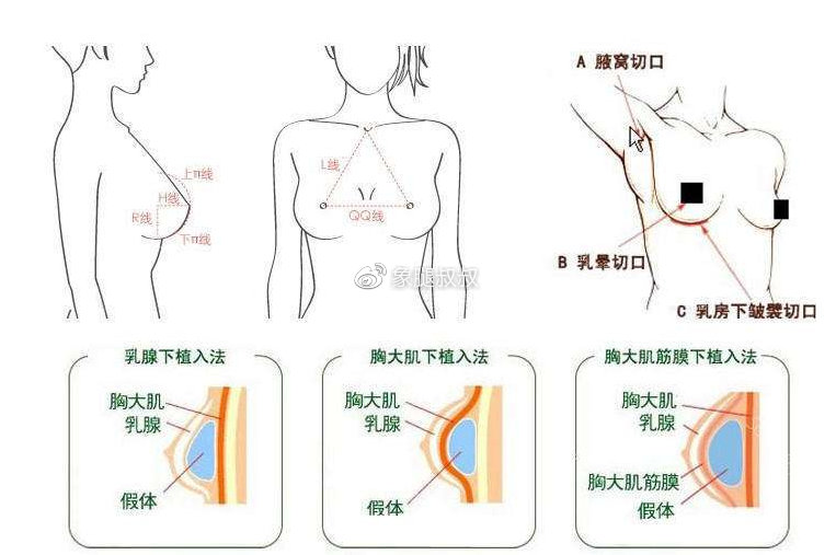 隆胸手术，了解、选择与恢复的全面指南