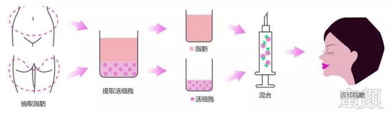 探索美丽新篇章，自体脂肪注射除皱的奥秘与魅力