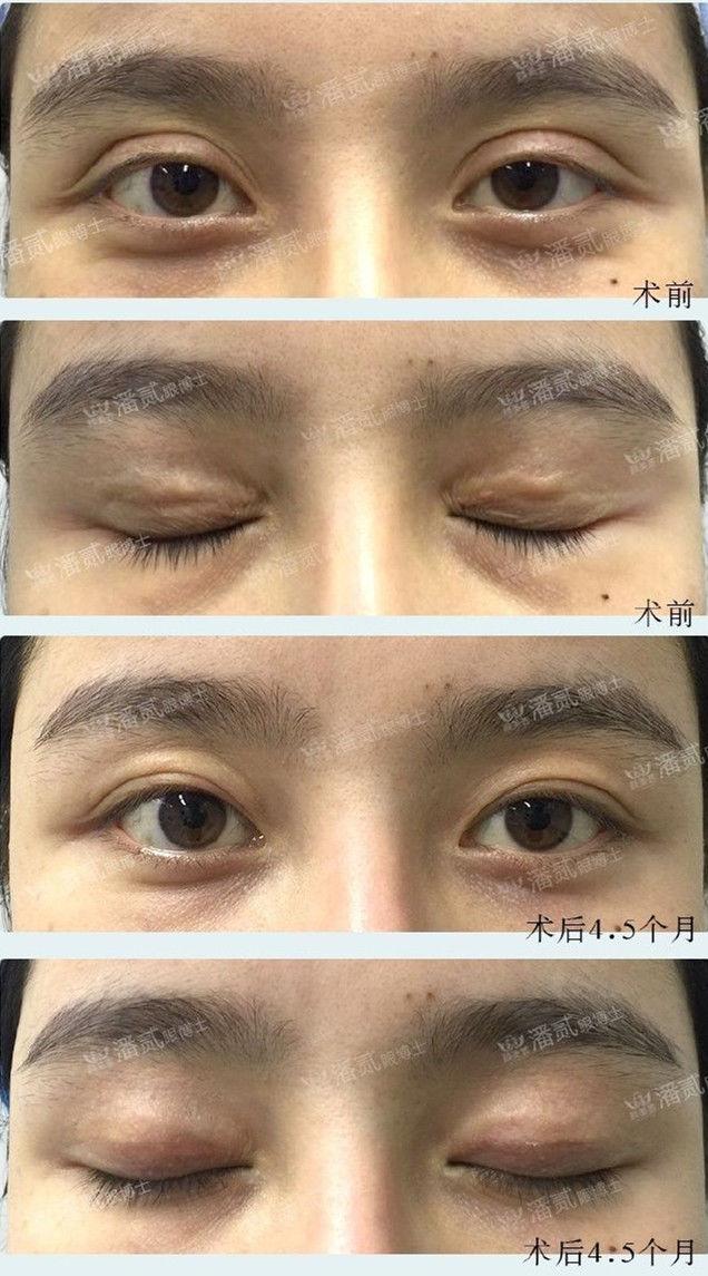 埋线双眼皮手术恢复全解析，从术后到自然的时间之旅