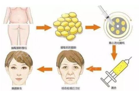 自体脂肪填充恢复期，从手术到重生的美丽旅程