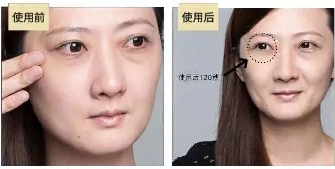 手术去除眼袋，重拾明眸光彩的现代选择