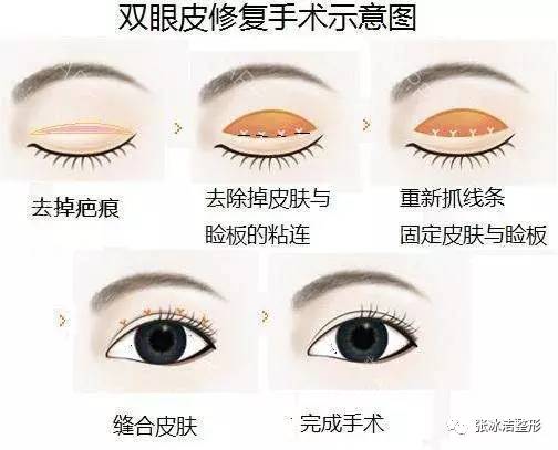 哪种双眼皮手术方式更自然、更持久？——全面解析双眼皮的好与不好