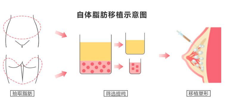 探索美丽新境界，自体脂肪移植隆胸的奥秘与魅力