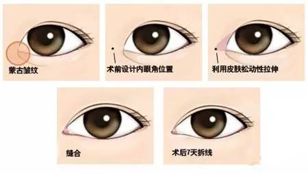 割双眼皮开眼角的美丽与风险，一次深度解析