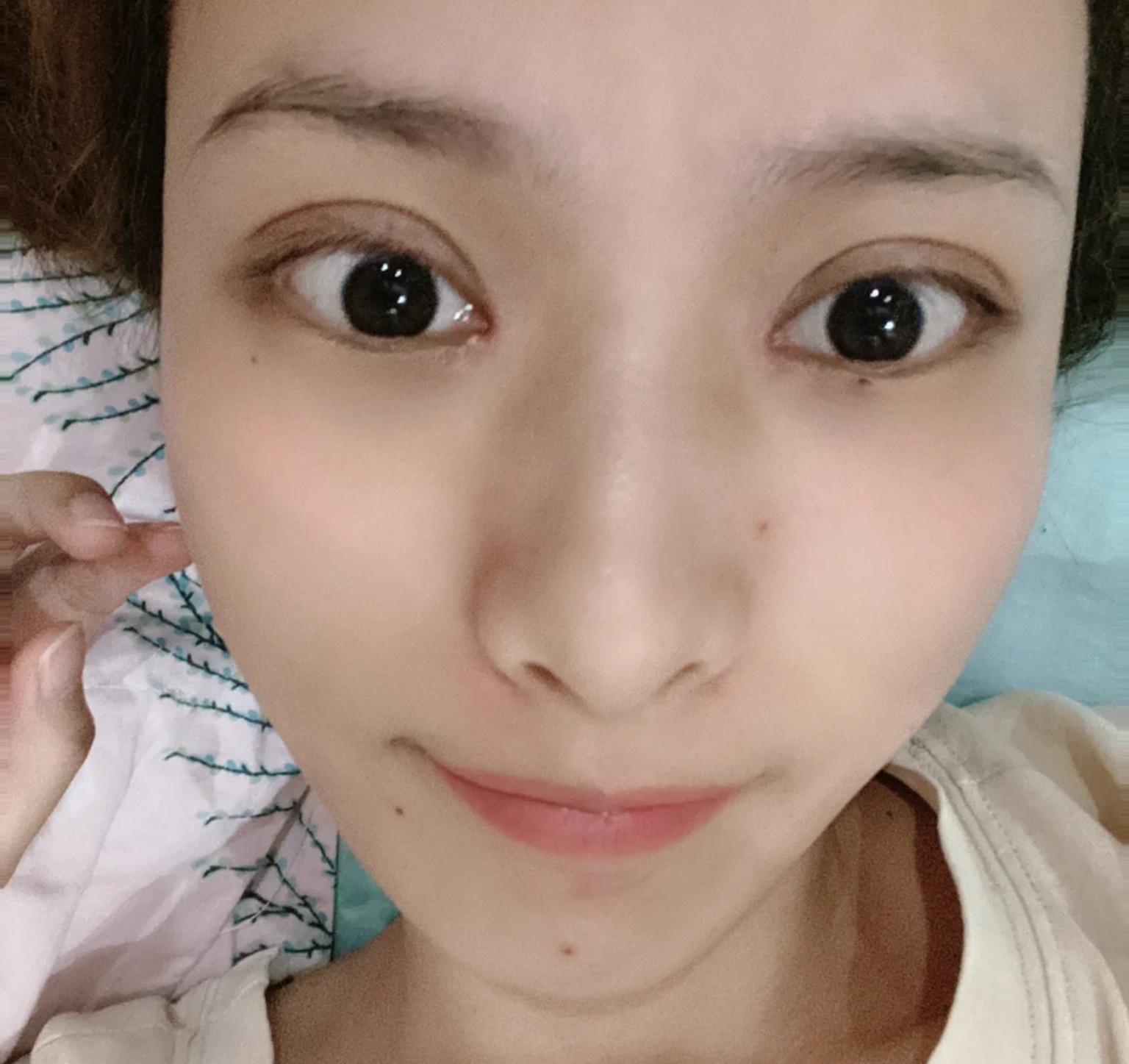 开眼角的潜在风险与考量