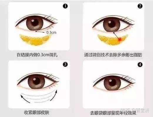 眼袋修复，重焕青春明眸的秘密武器