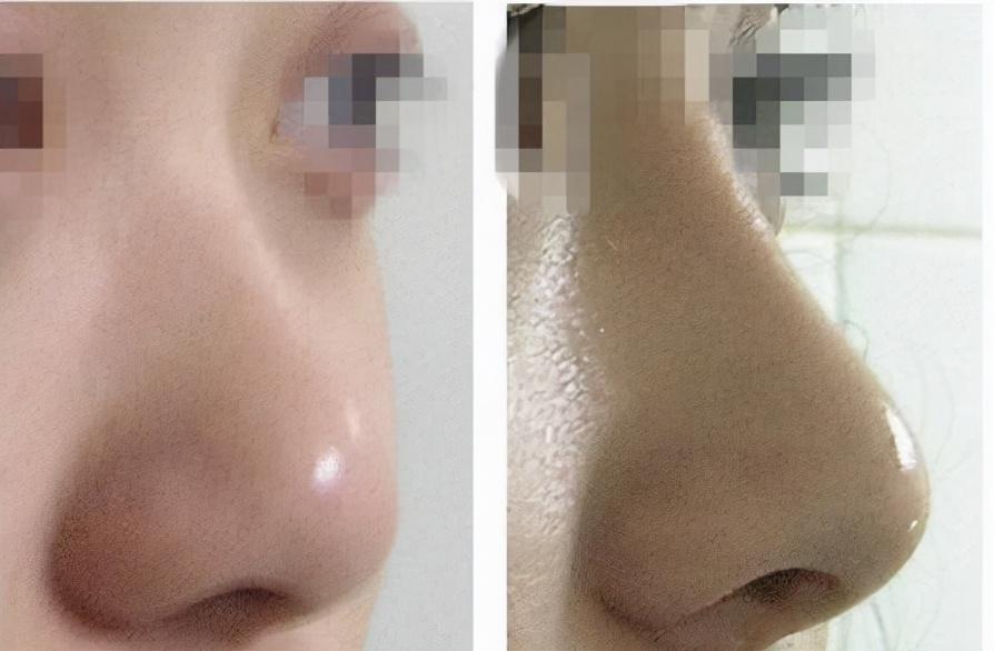 隆鼻假体取出的心路历程，从美丽到自然，重拾真实自我